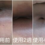 南投-石小姐：擦差不多兩個禮拜可以止癢、消腫，我非常感謝讓我找到救星了！