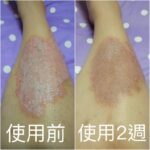 新北-黃小姐：才使用一周就有明顯改善，讓我10多年的小腿乾癬好了！