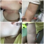 謝謝青黛萬用膏,讓我家小孩的皮膚有希望也不再痛苦!異位性皮膚炎