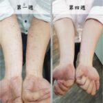 幫助改善雙手的異位性皮膚炎