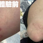 藍莓治乾癬